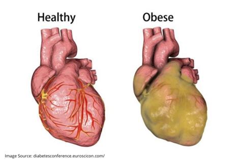 Is Heart Disease Related To Obesity