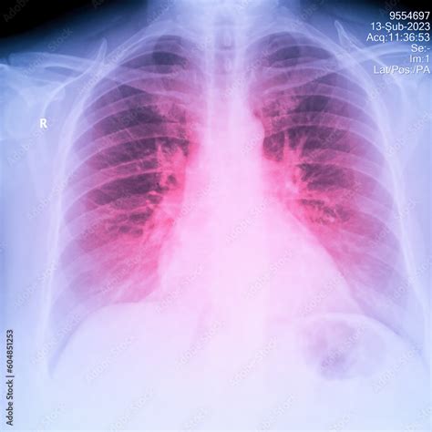 X-Ray Image Of Human Chest for a medical diagnosis, shows pain area ...