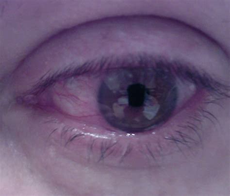 👉 Corneal Ulcer - Pictures, Symptoms, Causes, Treatment (November 2021)