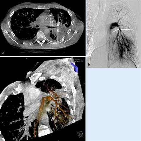 Abb A Pulmonale Metastasierung Bei Einem J Hrigen Patienten Mit