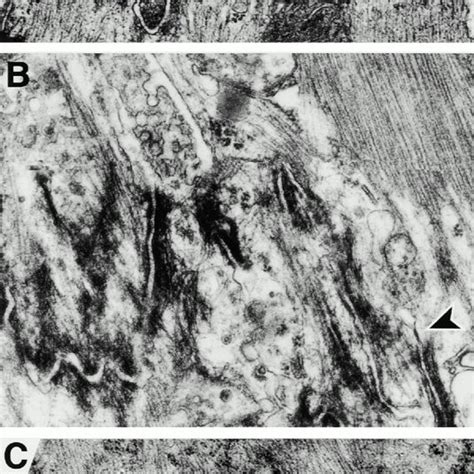 Electron microscopy of the altered intercalated disk morphology in ...