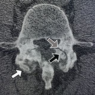 Facet joint osteoarthritis grade. (a) Grade 1 (normal): facet joint ...