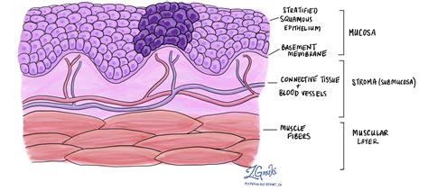 Squamous Cell Carcinoma Oral Cavity