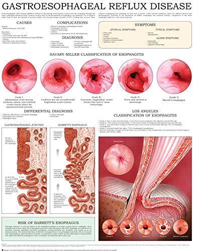 Gastroesophageal Reflux Disease E Chart Quick Reference Guide English