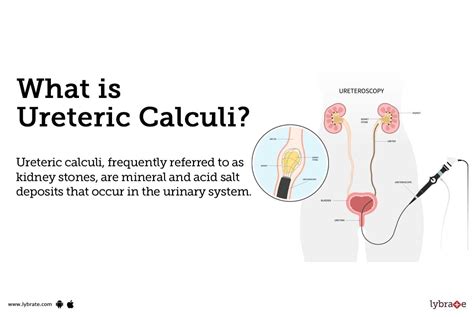 Ureteric Calculi Causes Symptoms Treatment And Cost