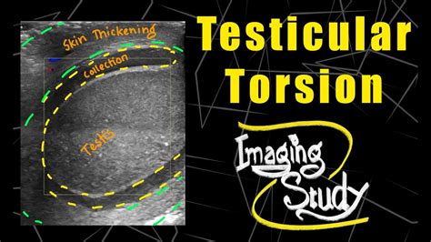 Testicular Torsion Ultrasound Doppler