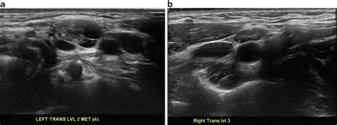 Cervical Lymph Nodes Ultrasound