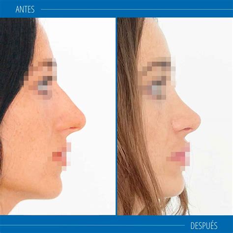 Rinoplastia Funcional Sevilla Y Mejora La Funci N Respiratoria