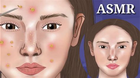 ASMR Acne Big Blackhead And White Head Removal Animation Satisfied