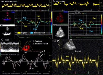 Doppler Tissue Imaging Improves Assessment Of Abnormal Interventricular