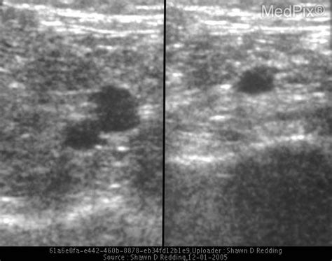 Superficial Thrombophlebitis Ultrasound