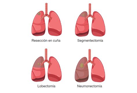 Resección pulmonar detalles de las cirugías Hospital de Bellvitge