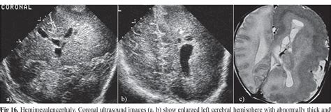 Figure From Neonatal Head Ultrasound Systematic Approach To