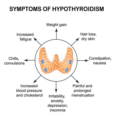 Tecken Av Hypothyroidism Thyroid Infographics Vektor Illustrationer