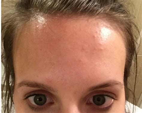 How I Cleared My Tiny Bumps On Forehead Once And For All Forehead