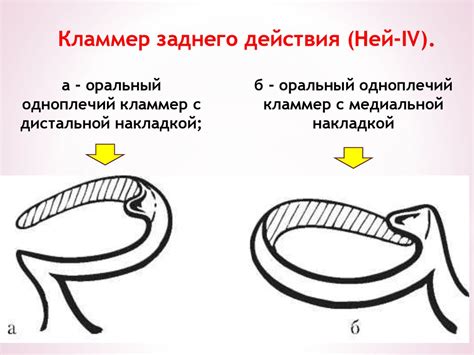 Кламмерная система - презентация онлайн