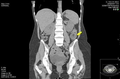 A Rare Case Of Adult Colocolonic Intussusception Of The Descending Colon Bmj Case Reports