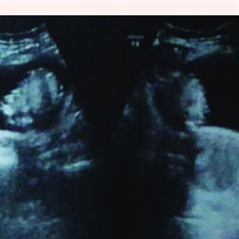 Pelvic Trans Abdominal Ultrasound Image Showing Echogenic Mass In The Download Scientific