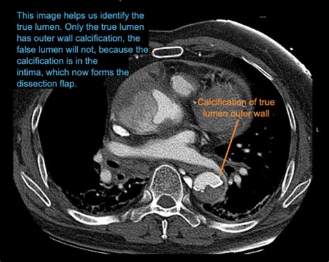 Ct Case Litfl Ct Scan Interpretation