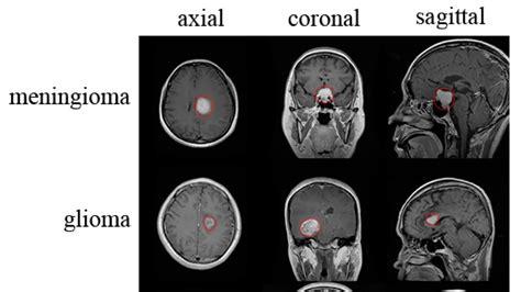 Understanding Meningioma And Glioblastoma A Deep Dive Into Brain Tumors