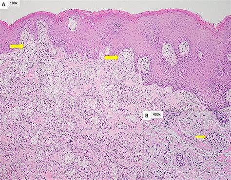 A The Tumor Is Present In Cords And Nests Of Epithelial And Clear Cells