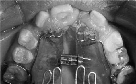 Pretreatment Occlusal Radiograph Showing The Dilacerated Impacted