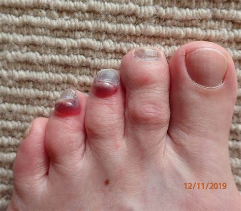 Toenail Blisters: 7 Causes, 7 Fixes - Blister Prevention