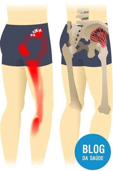 S Ndrome Dolorosa Miofascial O Que Causas Sintomas E Tratamentos
