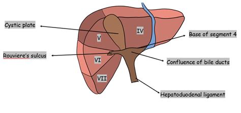 How To Perform A Safe Cholecystectomy Dr Magnus Jayaraj