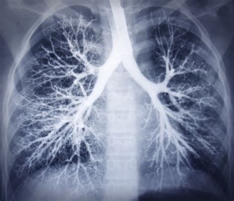 Minorities less likely to get recommended lung cancer imaging - UPI.com