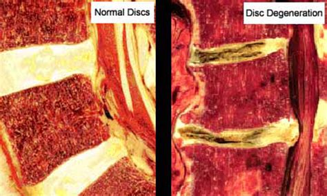 Learn All About Degenerative Disc Disease From A World Renowned Spine