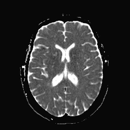 Cerebral Cavernoma Recent Hemorrhage And Associated Developmental