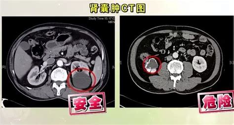 及時治療，別讓良性腎囊腫變成：「有危險特徵的腎囊腫」 每日頭條