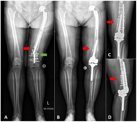 Shaft Fractures In Patients Requiring Primary Or Revision Total Knee Arthroplasty Can Be