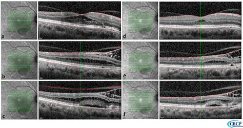 Figure 2 from A Patient With Optic Nerve Pit Maculopathy Successfully ...