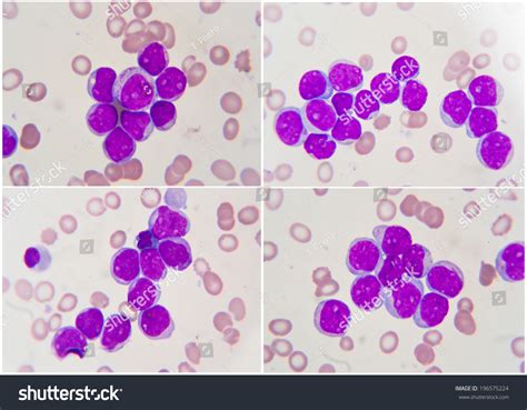 Leukemia Human Blood Cell Under Microscope Stock Photo 196575224