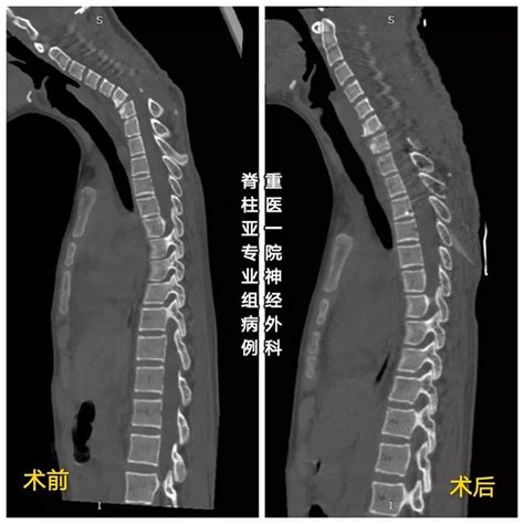 病例分享 頸髓內腫瘤術後頸椎後凸畸形 每日頭條