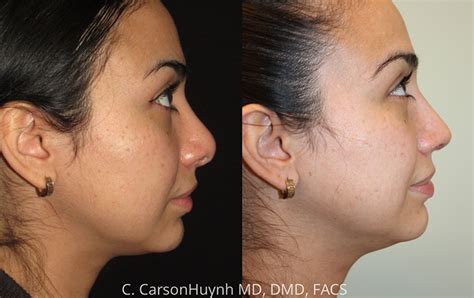 Rhinoplasty Case 3181 Radiance Surgery Aesthetic Medicine