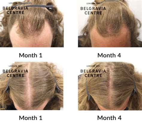 Hair Loss Success Story My Mind Was Blown After Seeing The Pictures