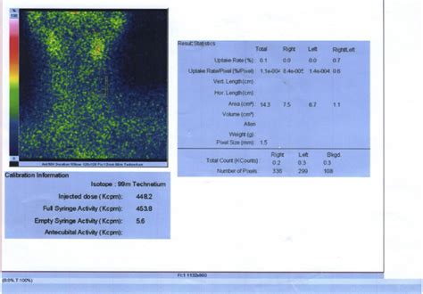 Technetium 99m Scan Showing Reduced Tracer Uptake In The Thyroid Gland