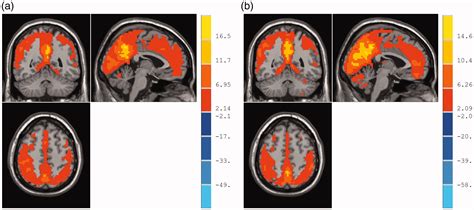 Abnormality Of Spontaneous Brain Activities In Patients With Chronic