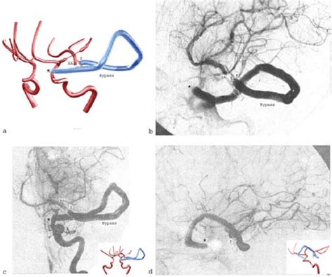 4 Postoperative Angiograms For Presentation Purposes We Created An Download Scientific