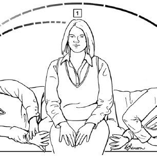 Depiction Of The Canalith Repositioning Maneuver Epley Maneuver For