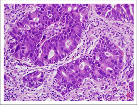 Higher Magnification Of Adenocarcinoma Of The Lung Note The Nuclear Download Scientific