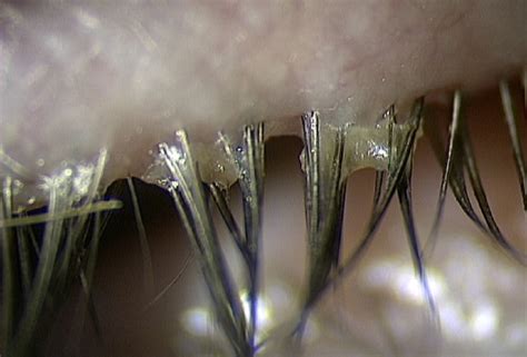 Blepharitis