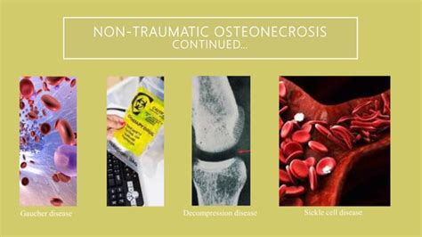 Osteonecrosis Ppt