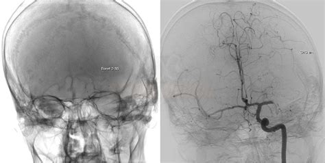 Digital Subtraction Angiography Dsa Stroke Manual