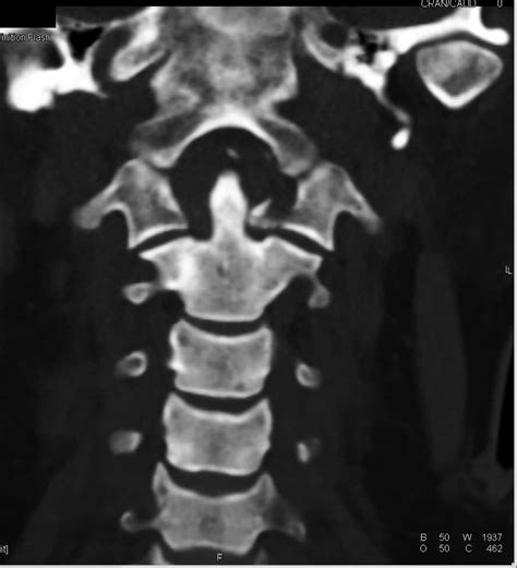 C Fracture Radiology | Hot Sex Picture