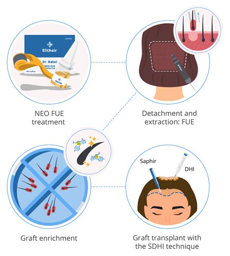 Sdhi Hair Transplant Get A Unique Treatment Elithair