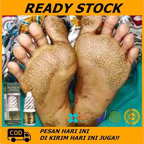 Jual Obat Telapak Kaki Bau Obat Penghilang Telapak Kaki Rayapan Obat